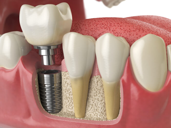 anatomy-of-healthy-teeth-and-tooth-dental-implant-2023-11-27-05-31-59-utc