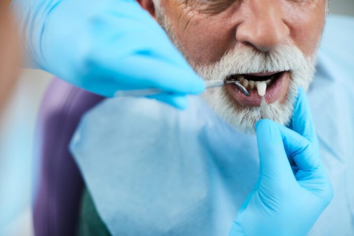 close-up-of-dentist-implanting-dental-veneers-on-s-2023-11-27-05-22-35-utc