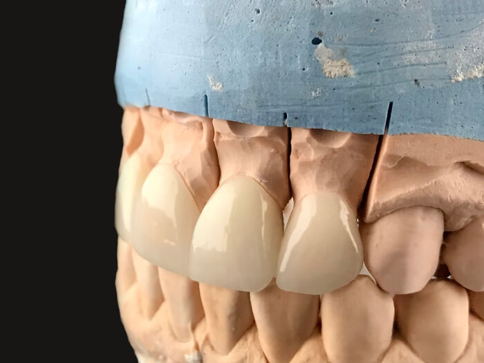 white-front-teeth-veneers-on-diagnostic-model-on-d-2023-11-27-05-17-50-utc